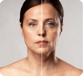 Rejuvenecimiento facial