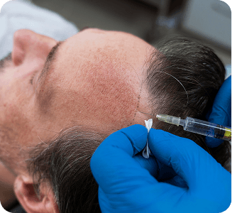 Injerto Capilar